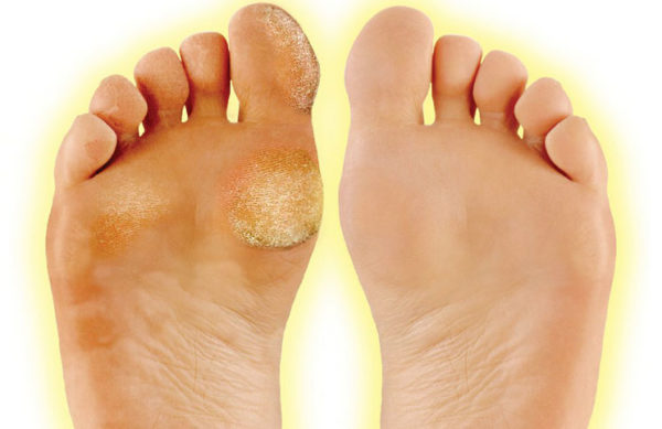 learn-how-to-treat-calluses-on-your-feet-check-it-out-learning-how-to